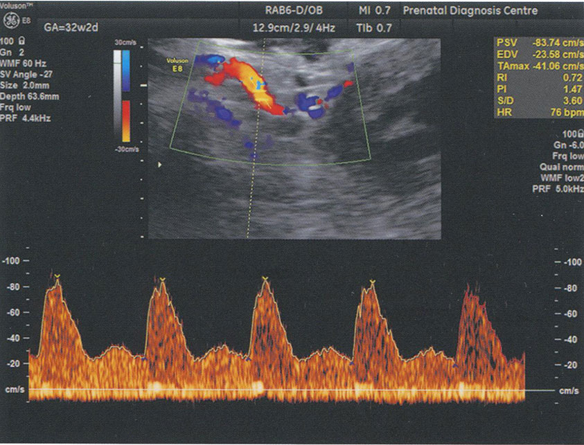 Исследование кровотока в маточной артерии в 32 недели 2 дня у пациентки с преэклампсией