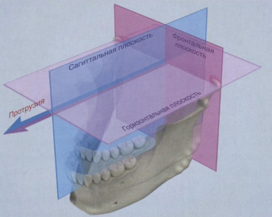 Протрузия нижней челюсти
