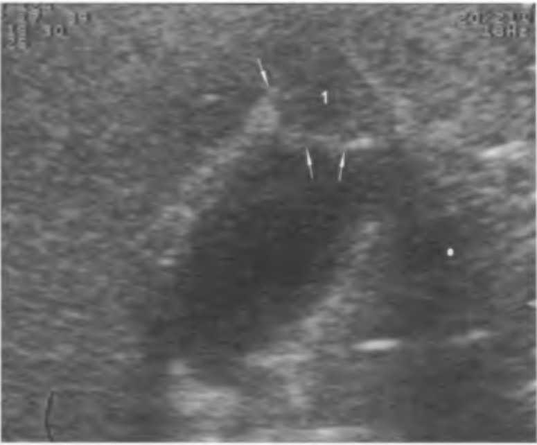  Аденомиоматоз желчного пузыря, локальная форма, фундальная аденомиома