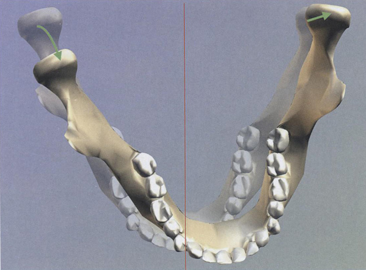 Начальный суставной сдвиг