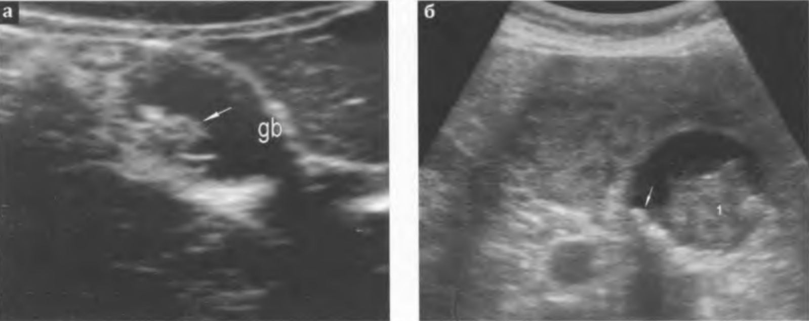 Рак желчного пузыря: а - по задней стенке пузыря