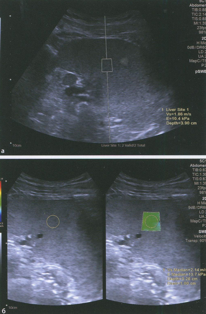 Селезенка в норме. Эластограммы: режим pSWE