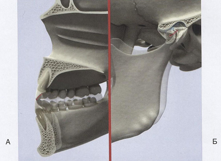 Перемещение зубов (А) и смещение мыщелка (Б) 