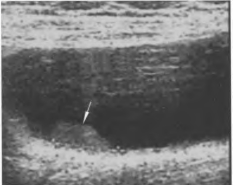 Желчный пузырь, продольный срез: в просвете пузыря