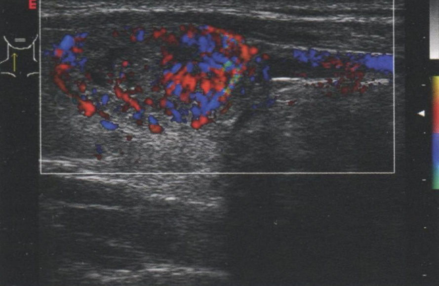 Васкуляризованный узел. Фолликулярный рак в нижнем полюсе щитовидной железы с выраженным кровотоком Васкуляризованный узел. Фолликулярный рак в нижнем полюсе щитовидной железы с выраженным кровотоком