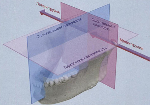 Смещение нижней челюсти вправо (латеротрузия в области правого височно-нижнечелюстного сустава и медиотрузия в области левого височно-нижнечелюстного сустава)