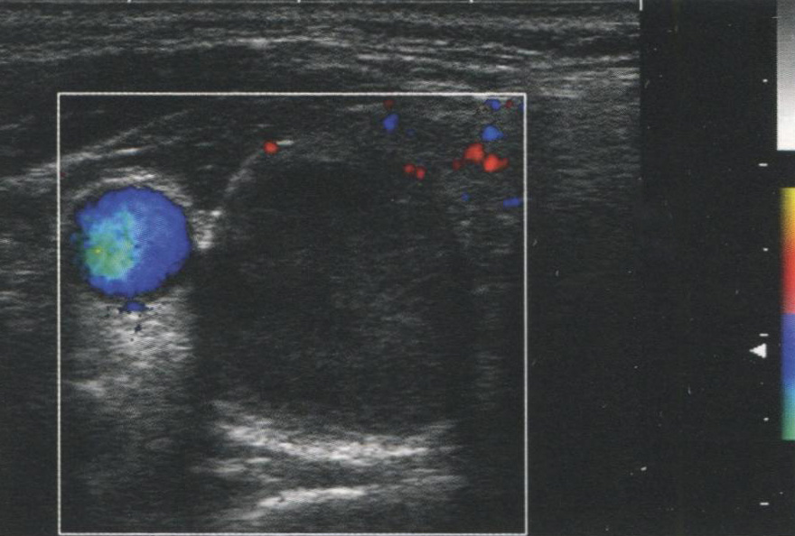 Аваскулярный узел. Доброкачественная фолликулярная аденома без внутриузлового кровотока Аваскулярный узел. Доброкачественная фолликулярная аденома без внутриузлового кровотока