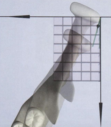Медиотрузия в области левого височно-нижнечелюстного сустава при латеротрузии вправо 