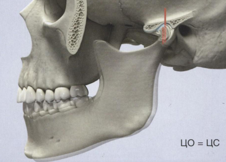 Ретрузия нижней челюсти из центральной окклюзии