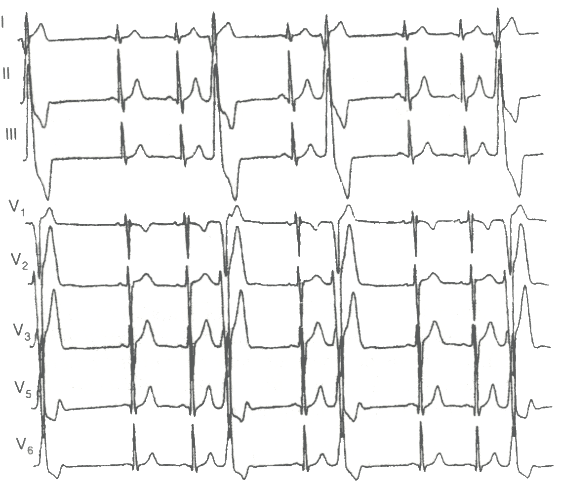 Мономорфные желудочковые экстрасистолы из выводного тракта правого желудочка