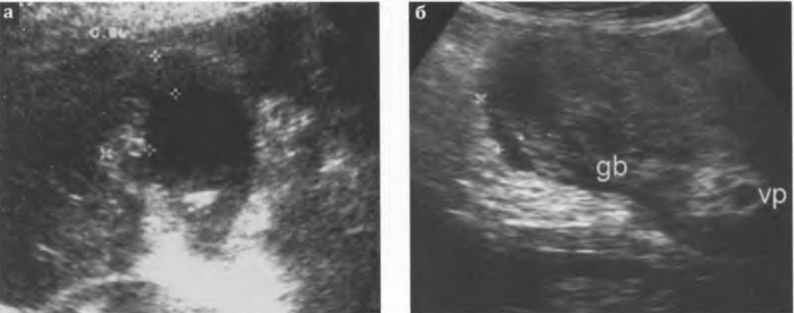  Гангренозный холецистит