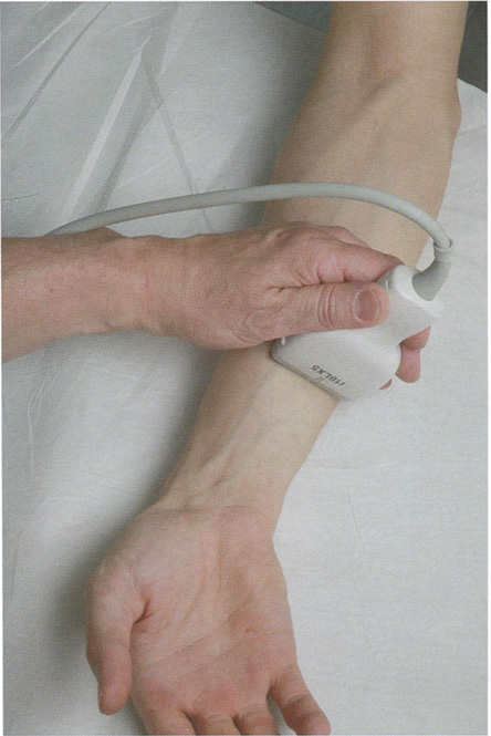 Рис. 3.90 Датчик устанавливают поперек предплечья ближе к локтевой поверхности, на границе его средней и дистальной третей