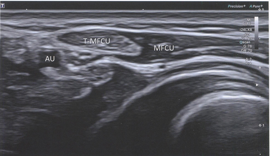 Локтевой сгибатель запястья (m. flexor carpi ulnaris; MFCU) с его сухожилием (T-MFCU) идут поверх тыльной ветви сразу после ее отхождения от локтевого нерва