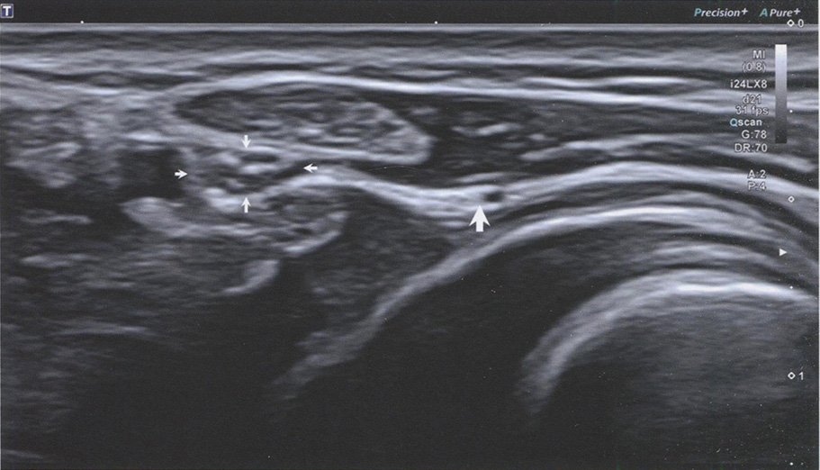 ТОВ тыльной ветви локтевого нерва