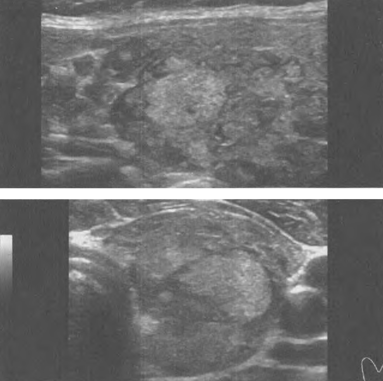 Узел 11,1х6, 8х10,5 мм левой доли ЩЖ у пациентки 67 лет. Тканевой (2 балла), изоэхогенный (1 балл)
