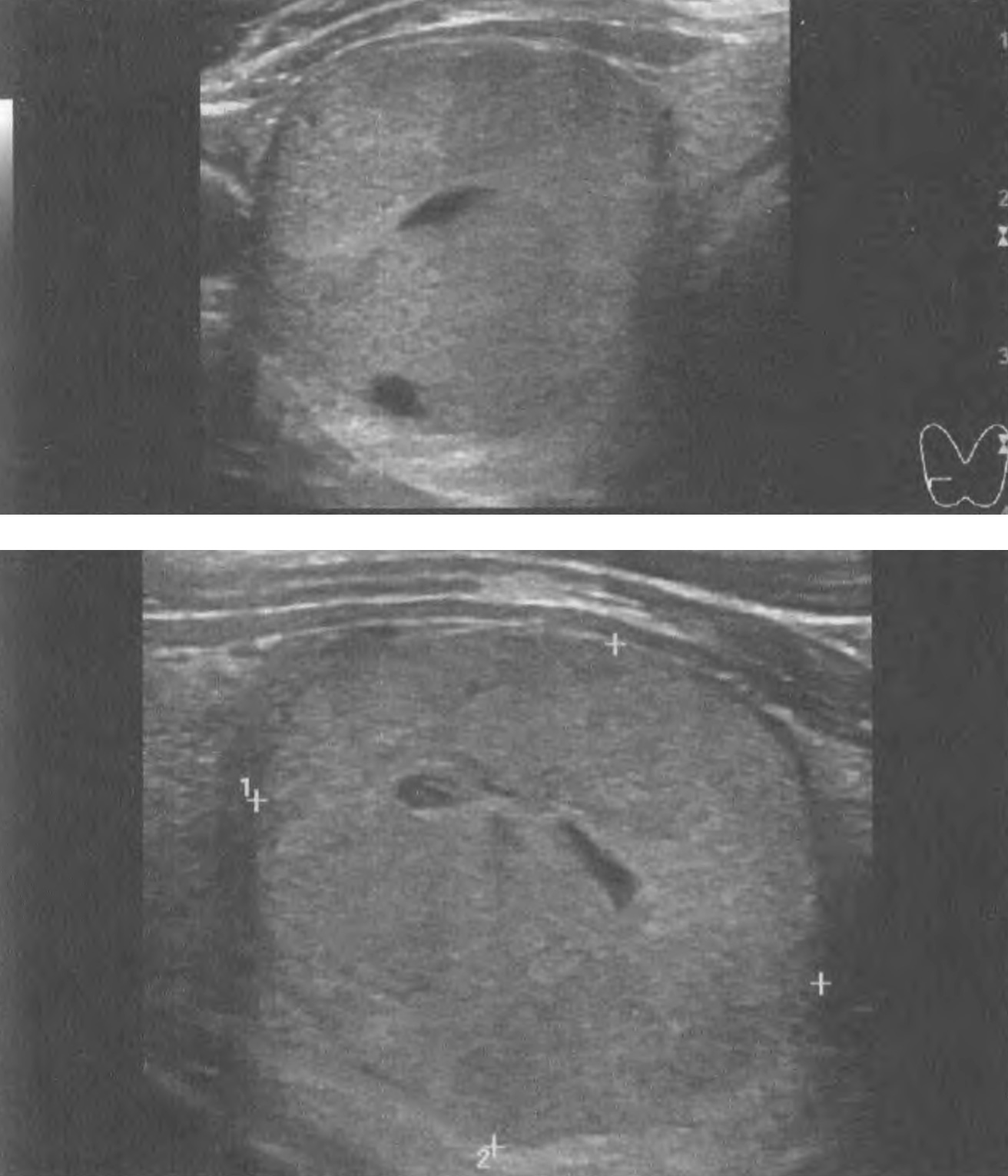 Узел 26, 1х27, 8х29,6 мм правой доли ЩЖ у пациента 46 лет. Тканевой (2 балла), преимущественно изоэхогенный (1 балл)