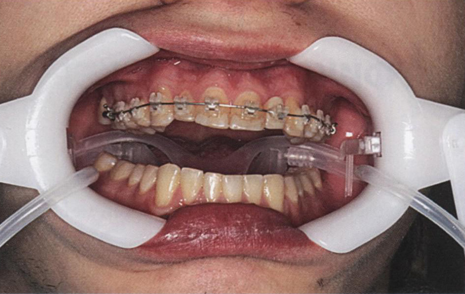 Ретрактор со слюноотсосом Nola Dry Field System