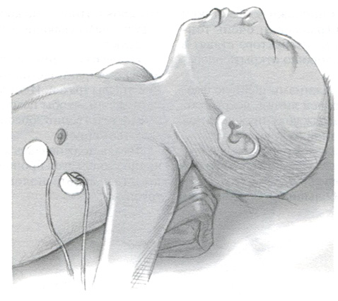 Ребенка укладывают на операционном столе