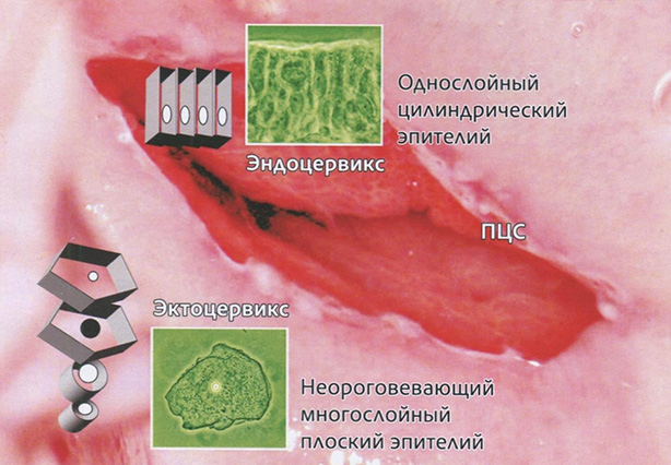 Рис. 4. Зоны шейки матки с выстилающим их эпителием ПЦС — линия стыка плоского и циллиндрического эпителиев