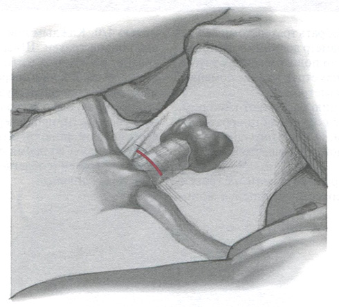 Разрез (лучше поперечный) производят по нижней складке