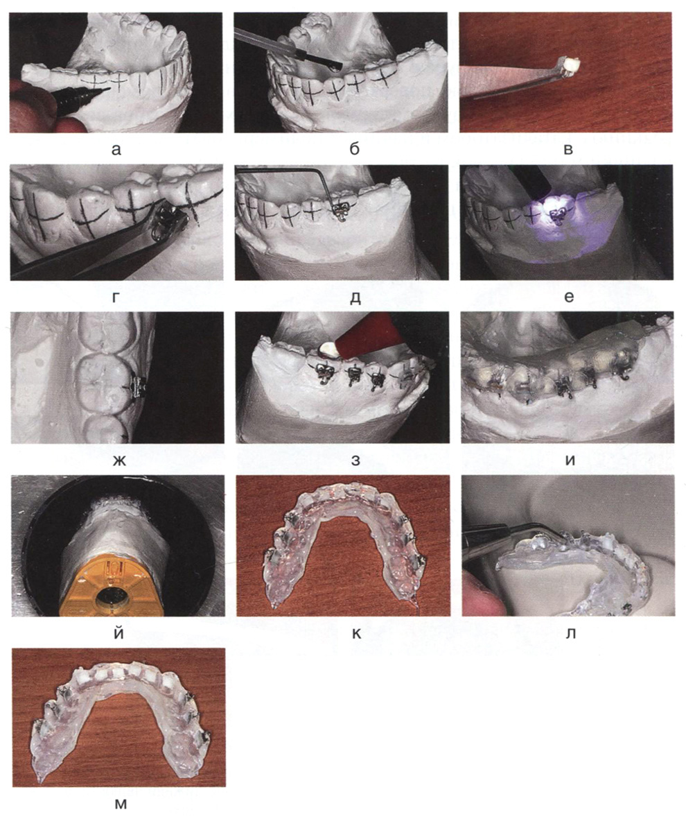 Лабораторные этапы непрямой фиксации
