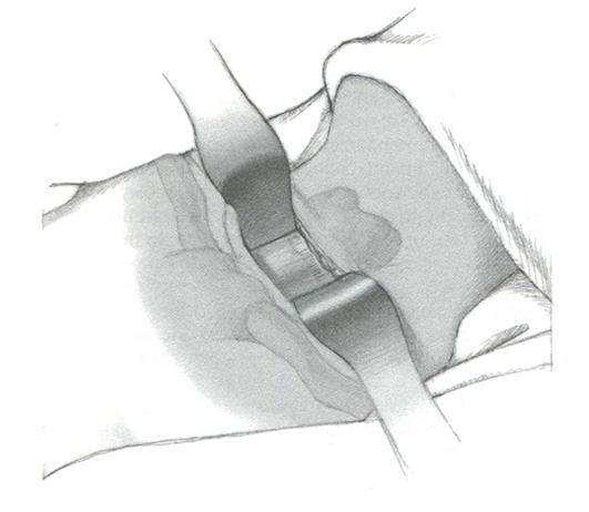 Разрез продолжают через подкожную фасцию