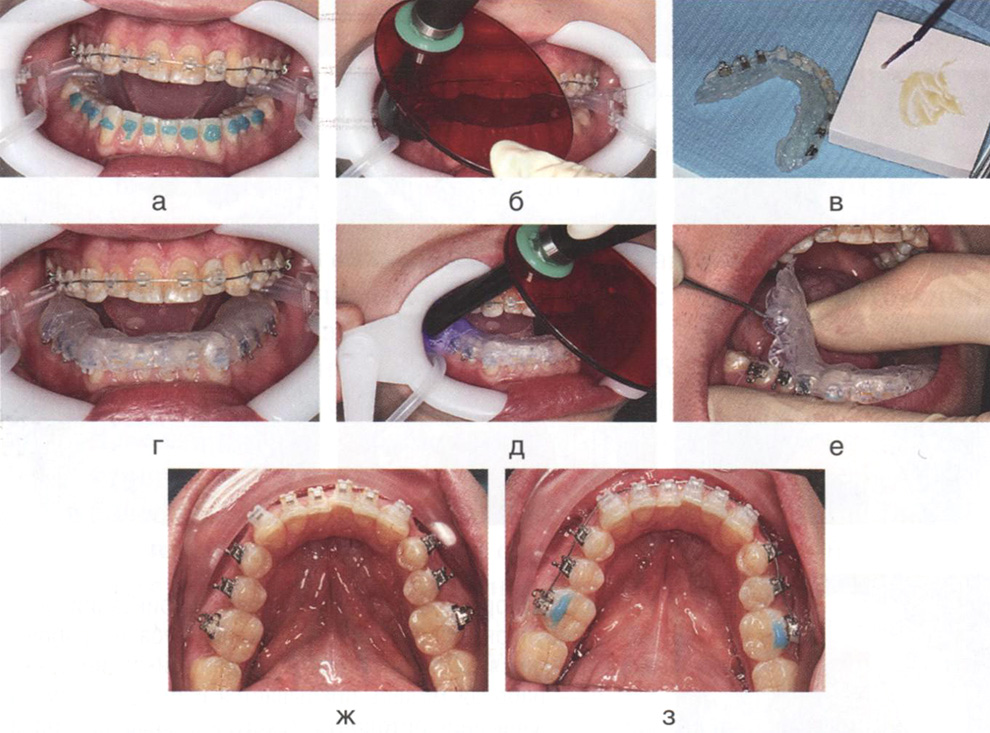 Клинические этапы непрямой фиксации