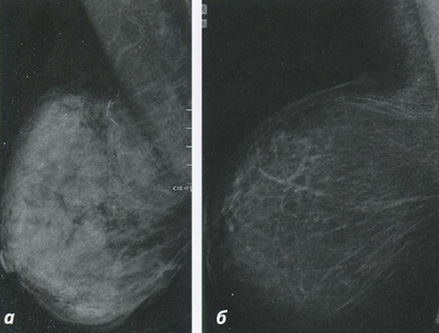 Рис. 4.3. Типы структуры паренхимы железы на маммограмме