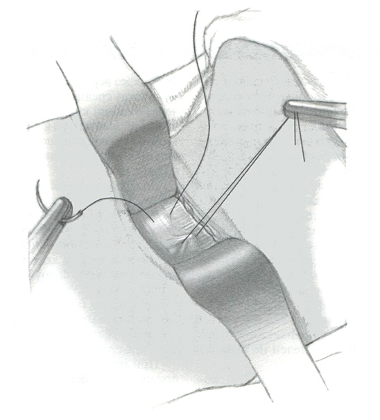 До операции следует подобрать трахеостомическую канюл