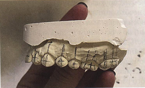 Разметка диагностической модели для техники непрямой фиксации