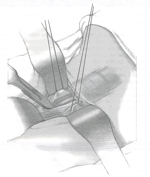 Хирург должен убедиться, что эндотрахеальная трубка готова
