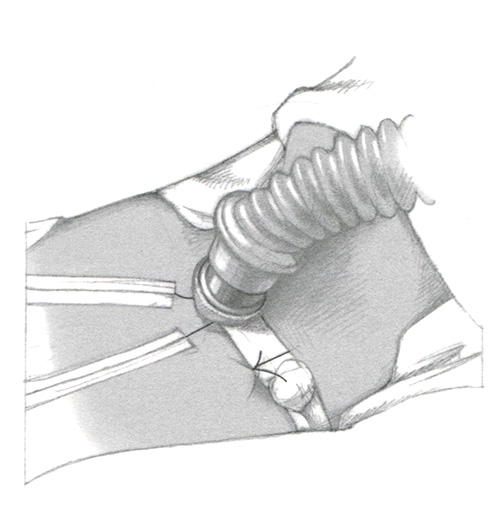 Как только канюля введена в трахею, удаляют обтуратор