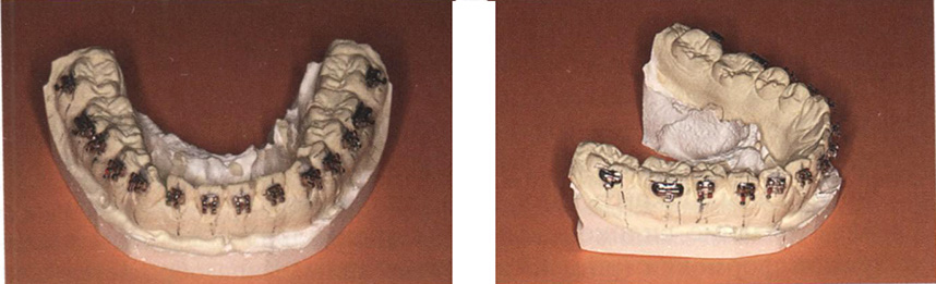 Брекет-система зафиксирована на диагностической модели непрямым бондингом