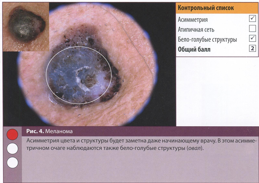 Рис. 4. Меланома