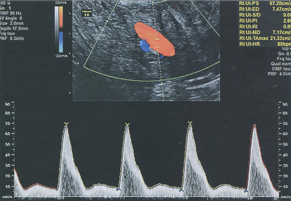 Эхографическое изображение в режиме триплексного картирования: измерение показателей кровотока в маточной артерии трансвагинальным доступом
