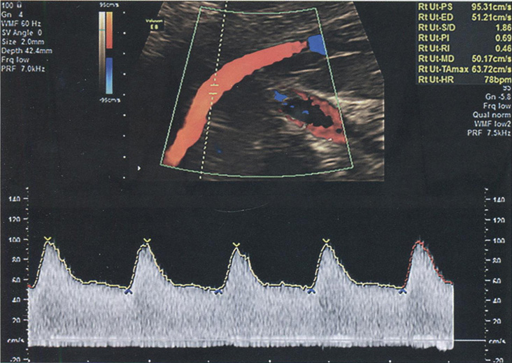 Эхографическое изображение в режиме триплексного картирования: измерение показателей кровотока в маточной артерии трансабдоминальным доступом в 21 нед беременности
