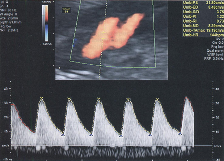  Эхографическое изображение в режиме триплексного картирования: измерение показателей кровотока в артерии пуповины