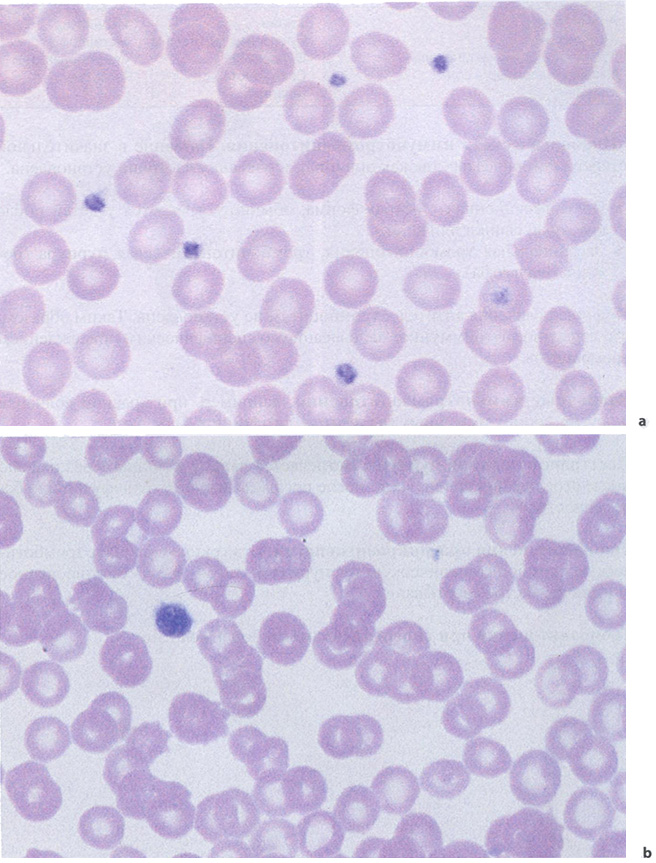 Формы тромбоцитопений