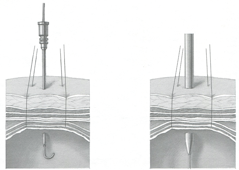 Анестезиолог проводит однопросветный орогастральный зонд в желудок и вводит через него 60&mdash;120 мл воздуха