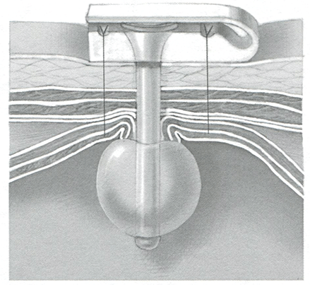 Гастростомическую трубку-«пуговицу» вытягивают на дилататоре 8F