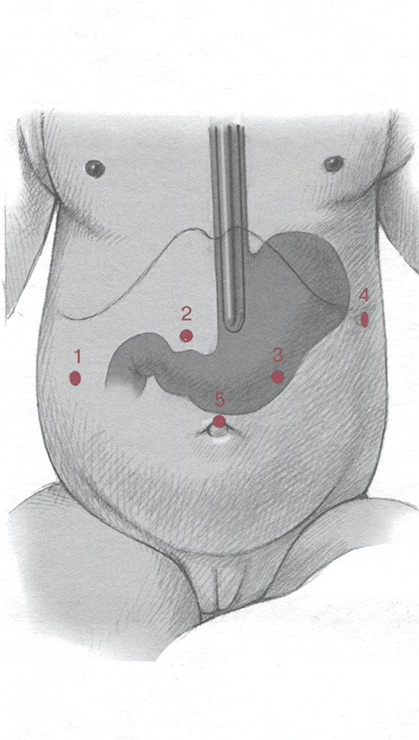 В брюшную полость вводят 5 троакаров