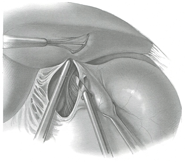 Диссекцию начинают с выделения острым путем верхней части печеночно-желудочной связки