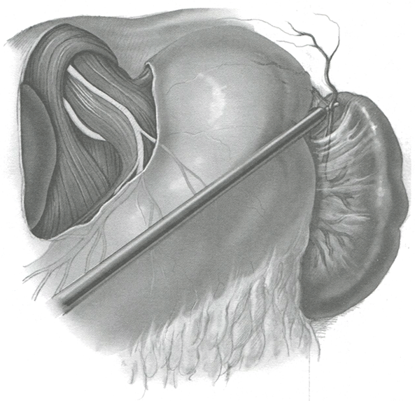 Короткие желудочные сосуды разделяют как обычно