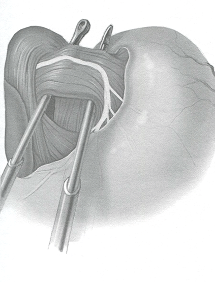 Левую ножку диафрагмы необходимо проследить по ее ходу вправо позади пищевода