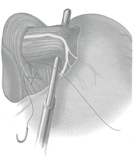 Ножки диафрагмы ушивают позади пищевода нерассасывающимися швами