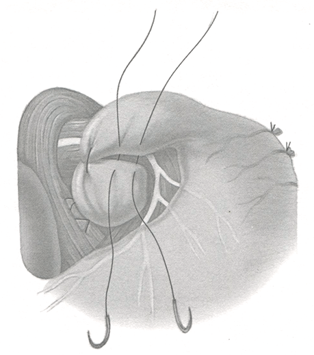 На этом этапе следует снова ввести в желудок буж