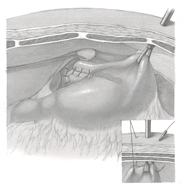 Гастростомией дополняют фундопликацию лишь в тех случаях, когда у пациента имеются нарушения глотания 