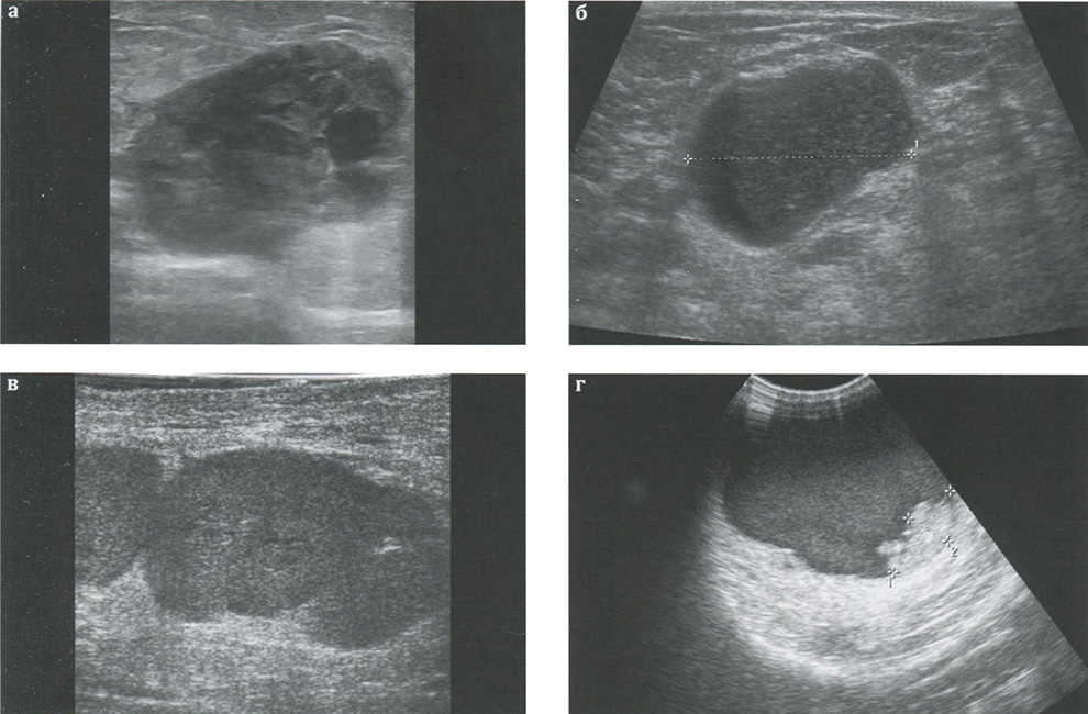 Визуализация отграниченных форм рака молочной железы в В-режиме