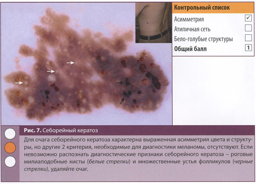 Рис. 7. Себорейный кератоз