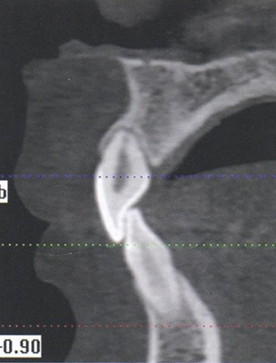 Оценка длины и формы корня зуба